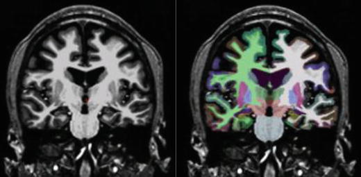 Structural and Quantitative MRI in Epilepsy | Neupsy Key