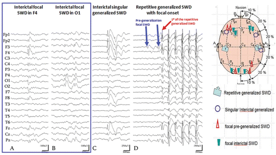 Introduction to Epilepsy and Related Brain Disorders | Neupsy Key