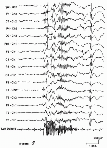 Atypical Absence, Myoclonic, Tonic, and Atonic Seizures | Neupsy Key