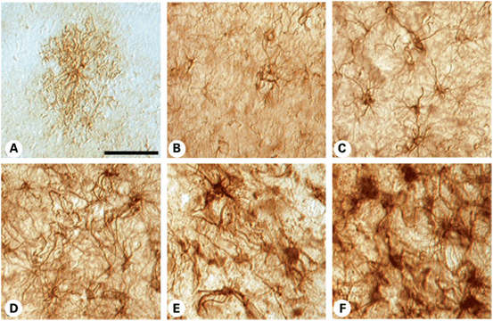 The Role of Astrocytes in Huntington’s Disease | Neupsy Key