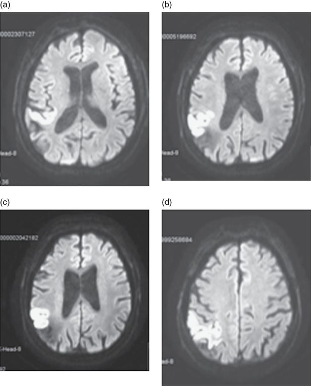 Transient Ischemic Attacks TIAs An Underrecognized And 