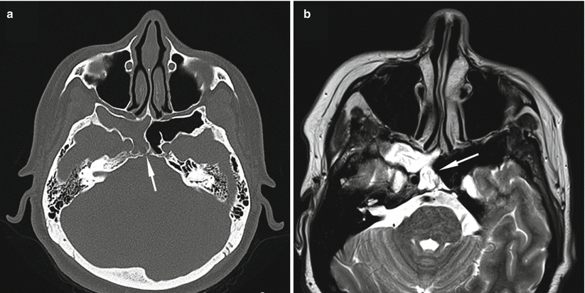 Spontaneous, Traumatic, and Postoperative CSF Rhinorrhea | Neupsy Key