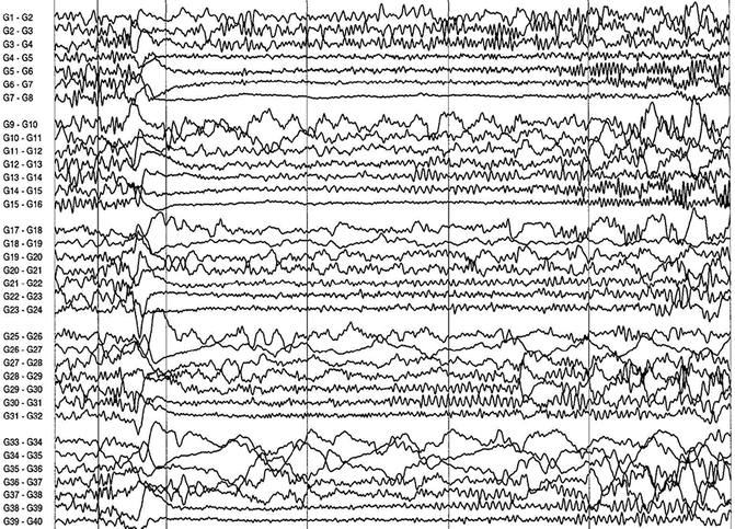 Electroencephalography | Neupsy Key