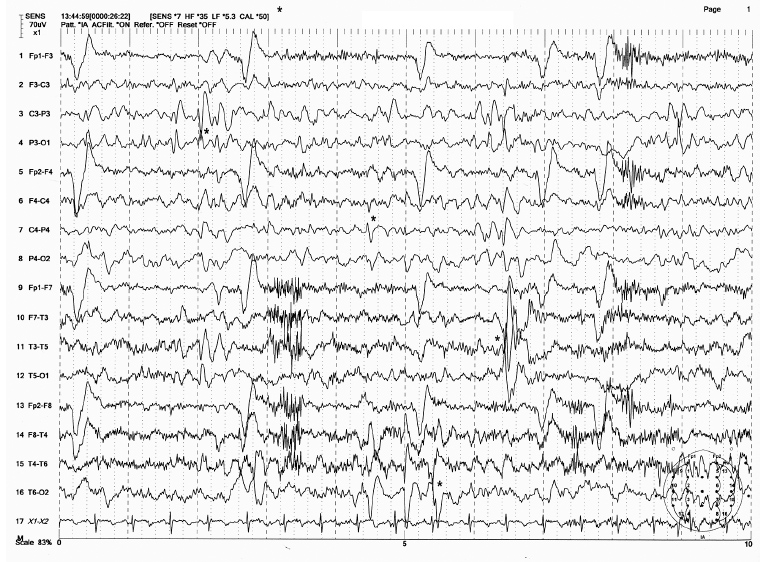 EEG Interpretation in Childhood Epilepsies | Neupsy Key