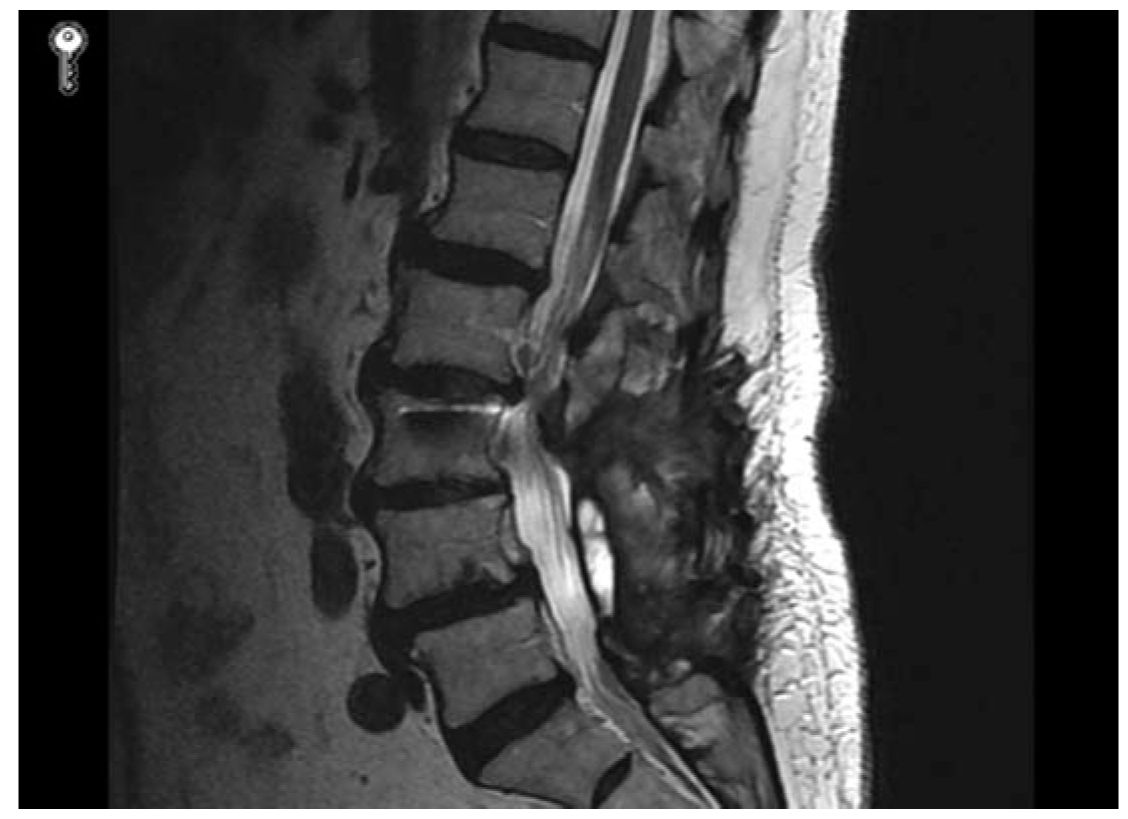 Approach to the Patient with Failed Back Syndrome Neupsy Key