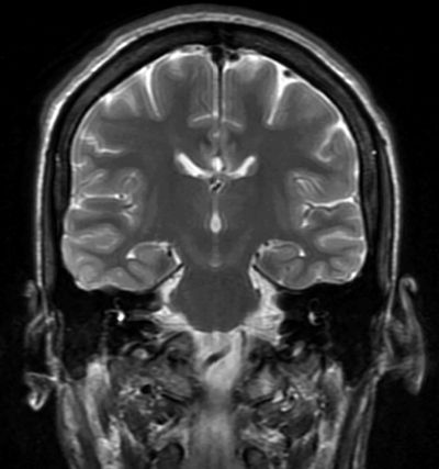 Corpus Callosotomy and Multiple Subpial Transection | Neupsy Key