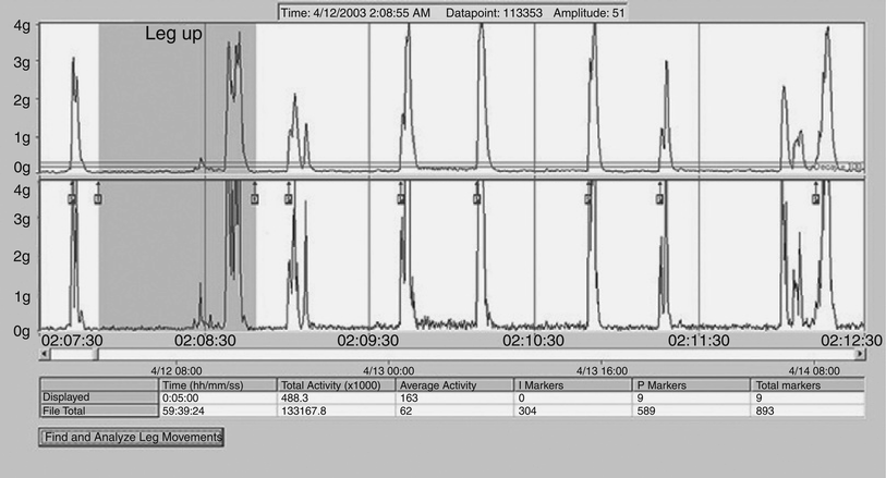 Motor Control and Dyscontrol in Sleep | Neupsy Key