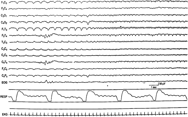 Neonatal EEG and Neonatal Seizures | Neupsy Key