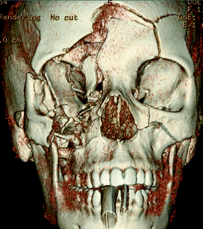 A326675_1_En_19_Fig10_HTML.gif