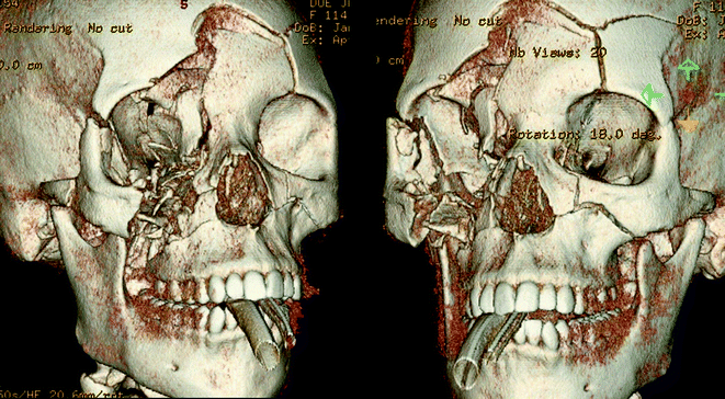A326675_1_En_19_Fig11_HTML.gif