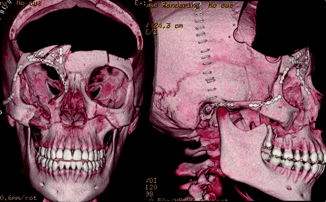 A326675_1_En_19_Fig13_HTML.gif