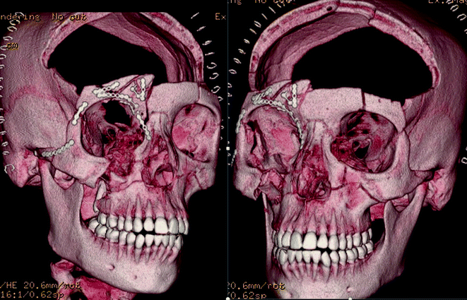 A326675_1_En_19_Fig14_HTML.gif