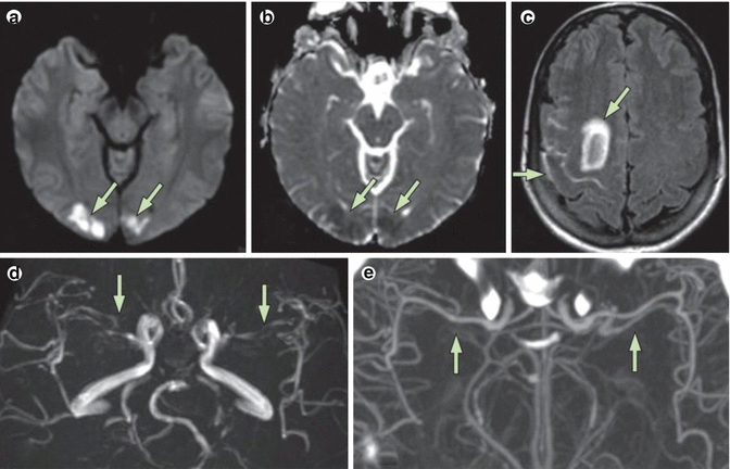 Central Nervous System Vasculitis | Neupsy Key