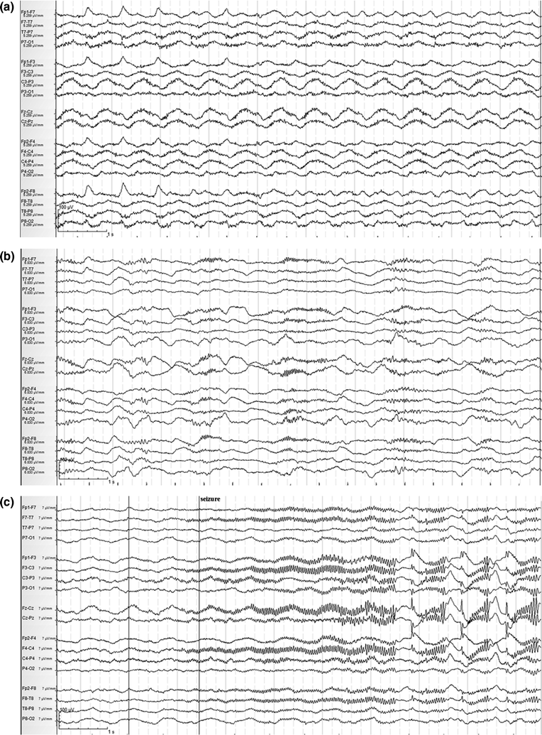 Unusual Causes of Status Epilepticus | Neupsy Key