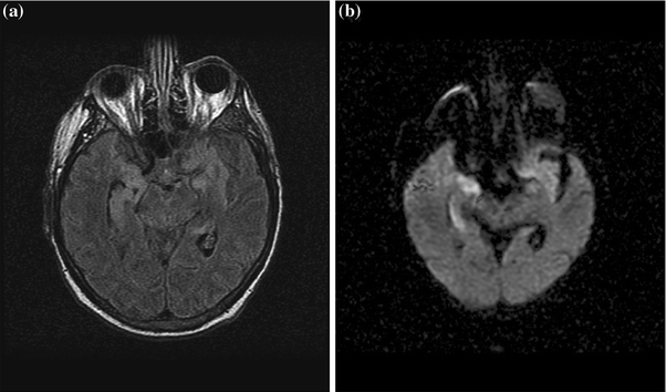 Neurologic Complications of Hematopoietic Stem Cell Transplantation ...