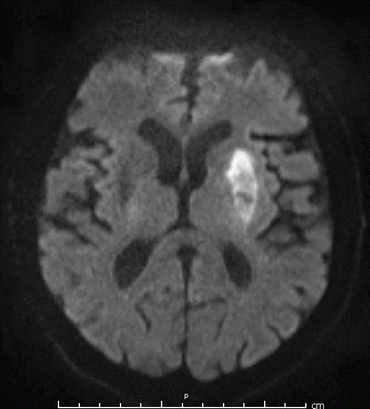 Mechanical Thrombectomy for Acute Ischemic Stroke | Neupsy Key