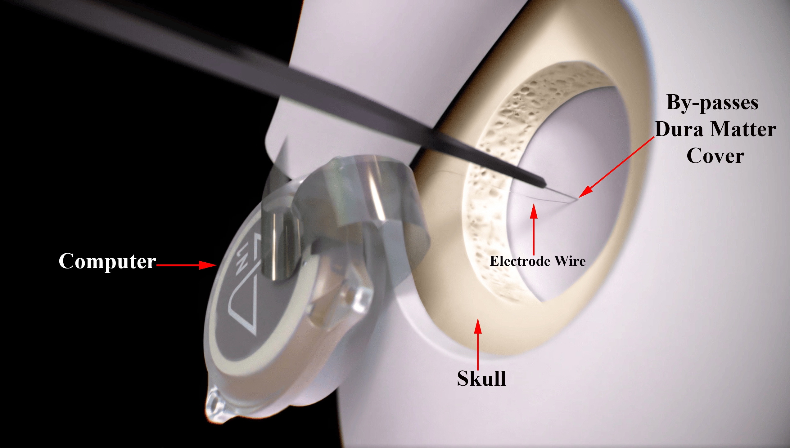 Neuralink’s further Centralization of Implant Surgery will Leave Patient’s in the Dark