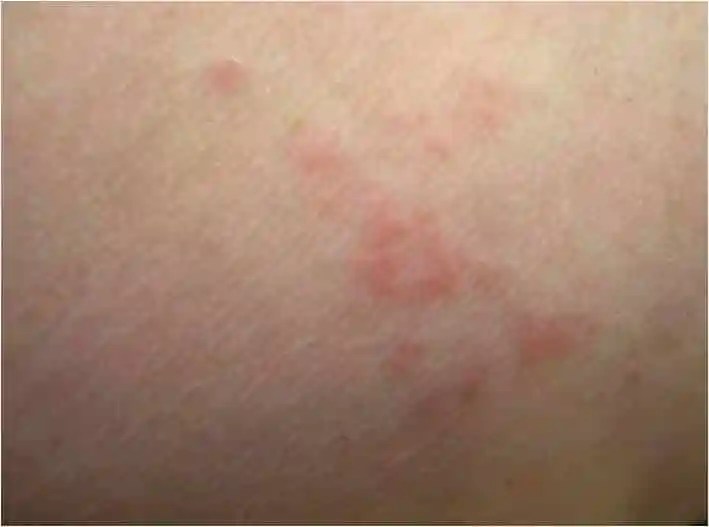 Red welts on skin from bed bug bites, useful for bug bite identification