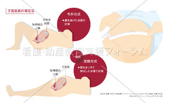 子宮底胎盤位於子宮宮底正常嗎 Vqpb