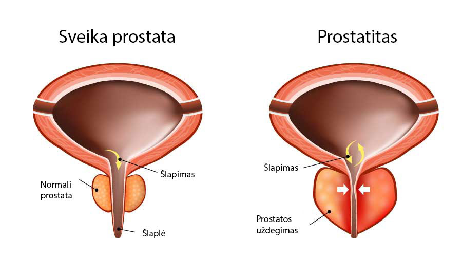 prostatitas