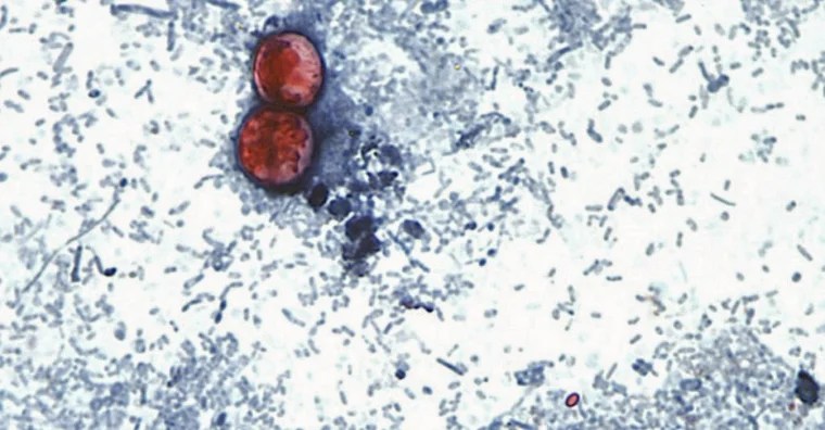 Cyclospora ha Atacado a 48 Personas en Texas