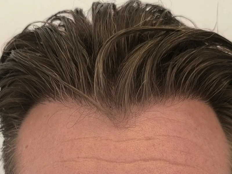 Ca. 12 måneder efter hårtransplantation