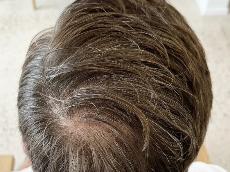 Ca. 12 måneder efter hårtransplantation