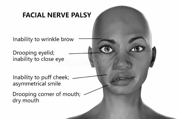 Facial Palsy