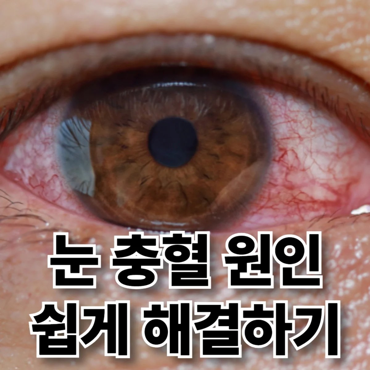 (눈 충혈 원인) 충혈된 눈 클로즈업 이미지