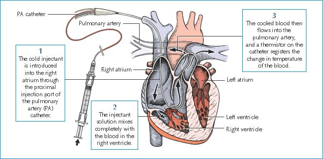 Thermodilution and Pulmonary Artery Catheter Setup