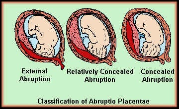 Die gießener allgemeinärztin kristina hänel gibt nicht auf: Nursing Care Plan Abruptio Placenta Nursing Crib