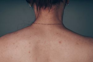 what causes body acne what causes body acne