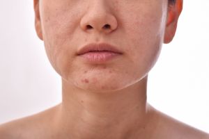 acne scars acne scars