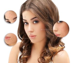 keep acne at bay
