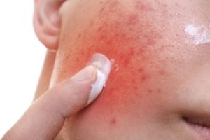 red irritated skin