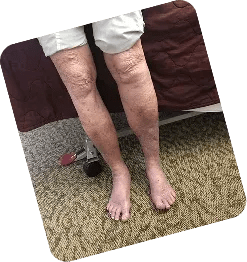 Skin Changes (Stage 4)