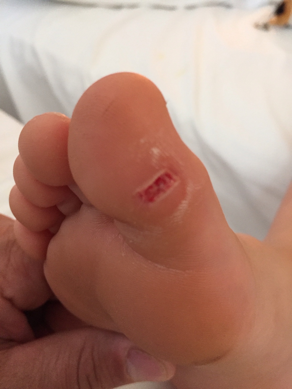 My bloody toe