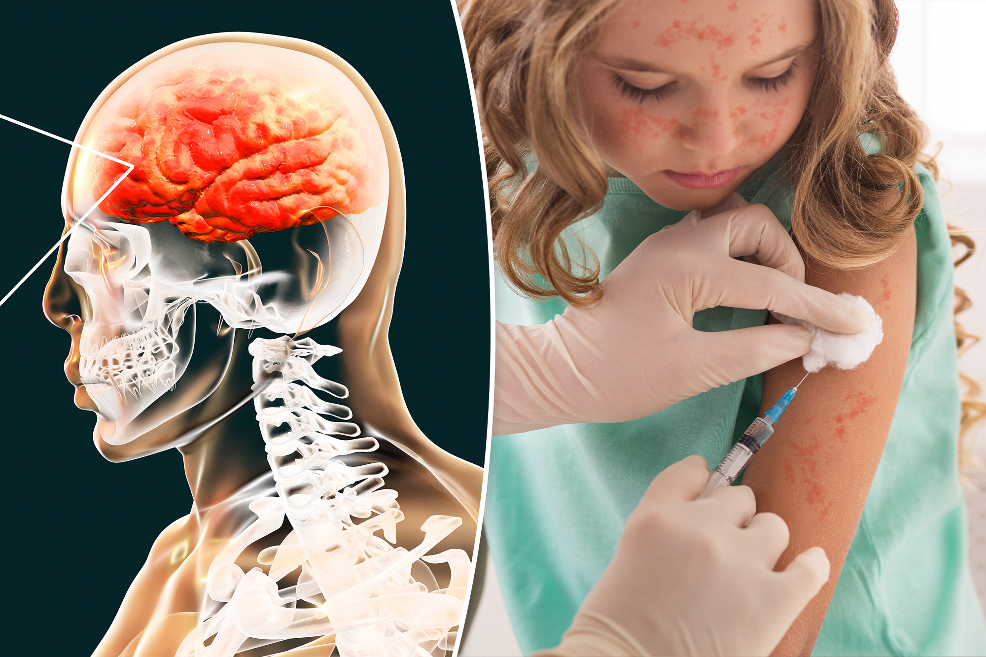 The horrific measles complication that can kill you years later — as nearly 200 cases confirmed across US