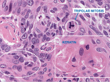 Neoplasia Nomenclature Epidemiology Flashcards Quizlet