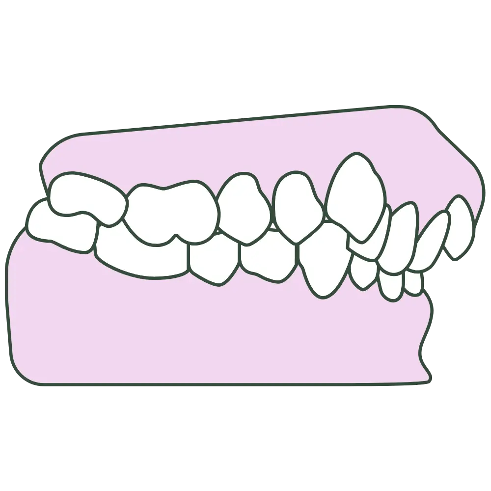 crowding jaw profile