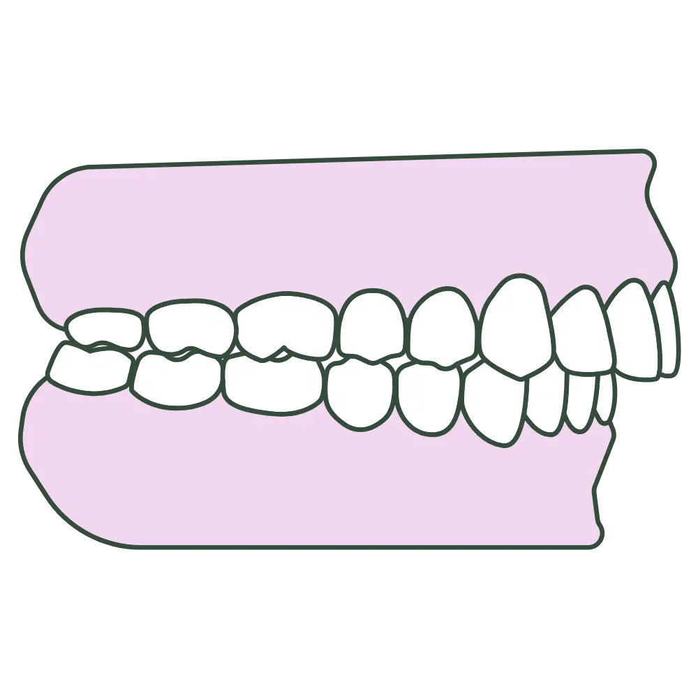 overbite jaw profile