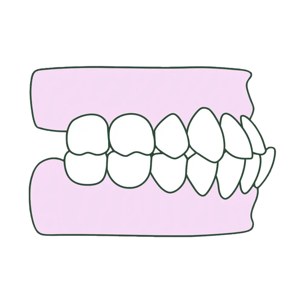 correct underbite with orthodontics