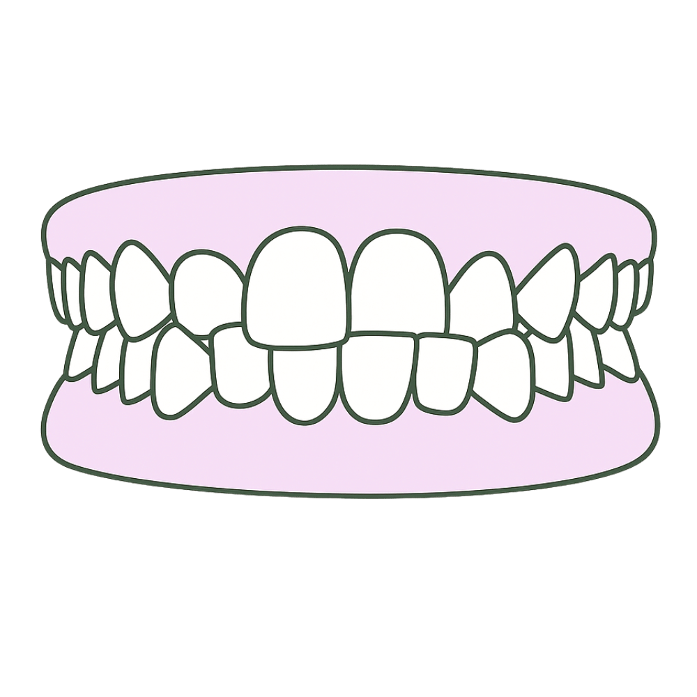 front view of an anterior crossbite