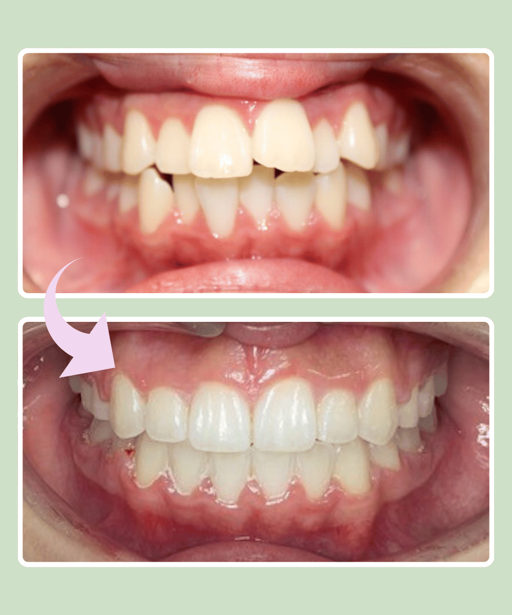 Patient 5 before and after braces