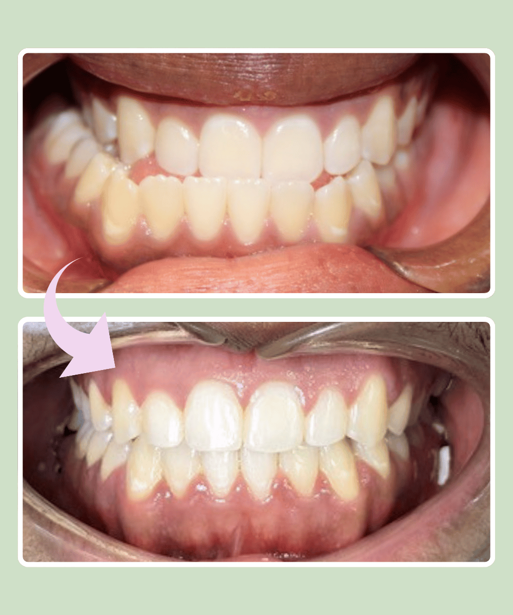 Patient 6 before and after braces