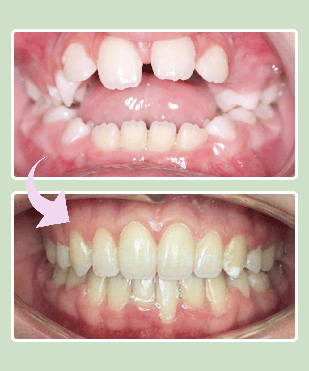 Patient 7 before and after braces