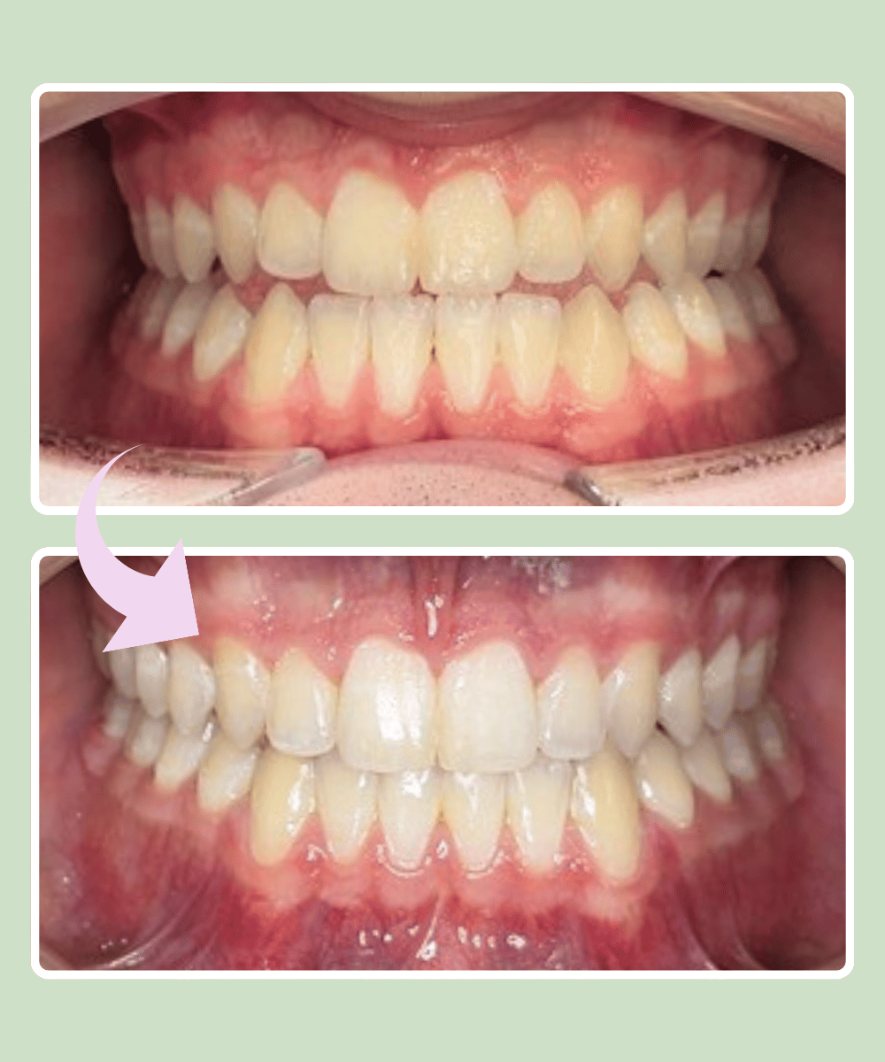 Patient 8 before and after braces