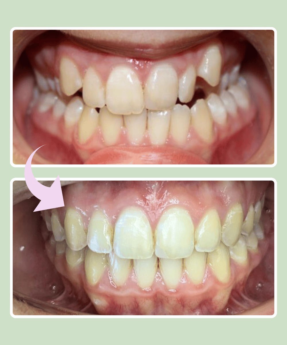 Patient 2 before and after braces