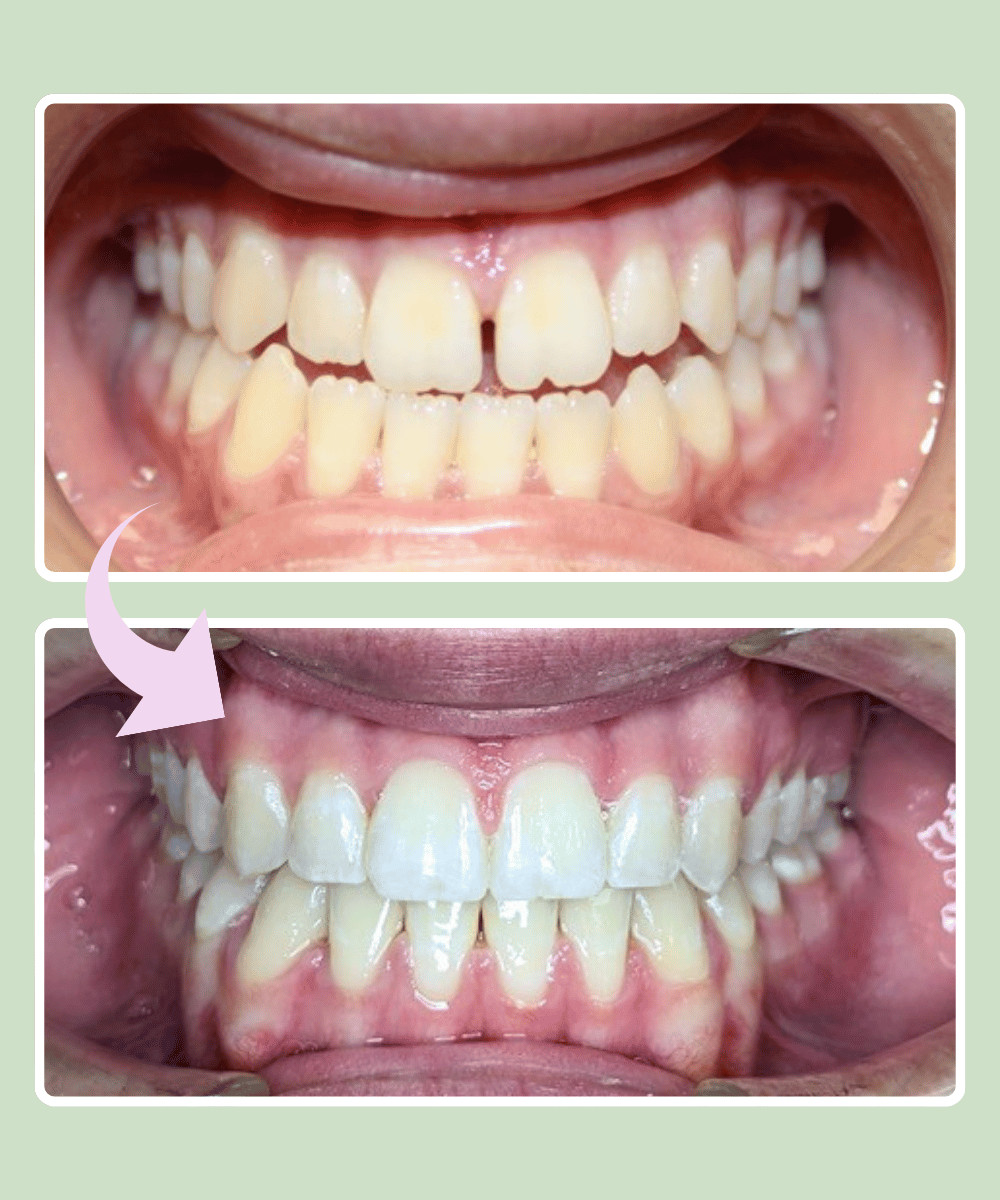 Patient 3 before and after braces