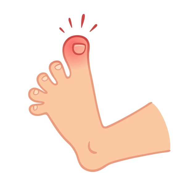 nail trauma
